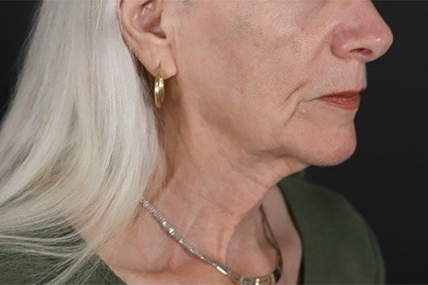 Deep Necklift Before & After