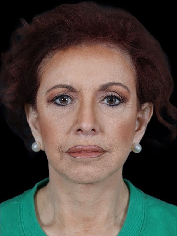 Deep Necklift Before & After