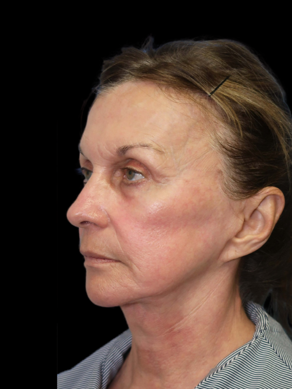 Deep Necklift Before & After