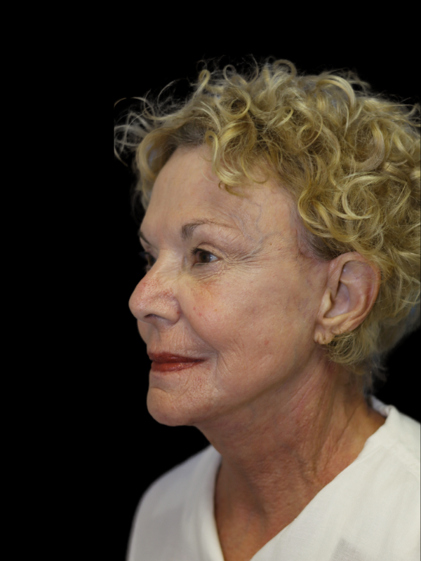 Deep Necklift Before & After