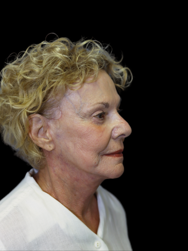 Deep Necklift Before & After