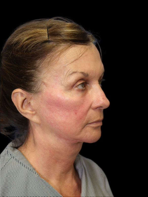 Deep Necklift Before & After