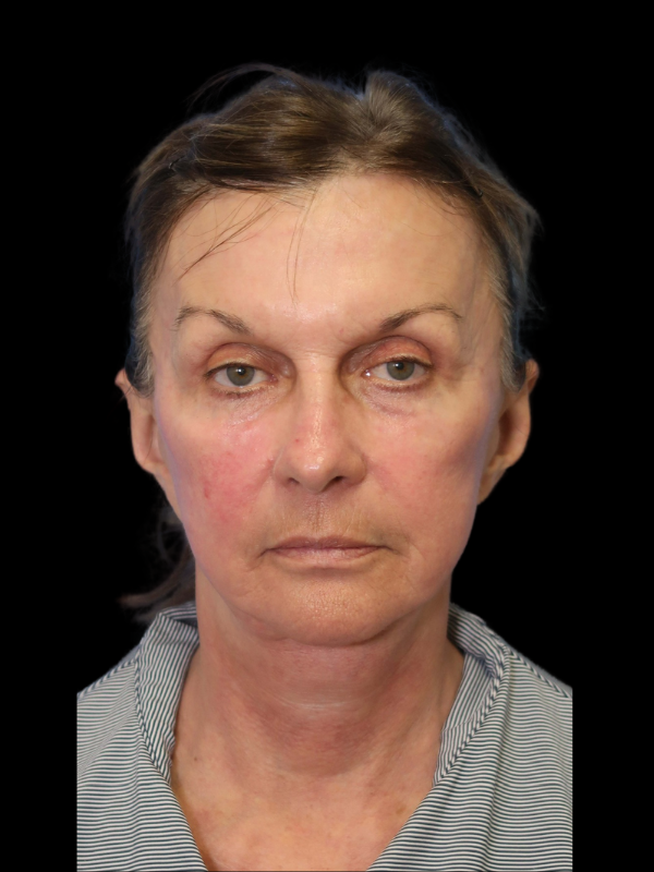 Deep Necklift Before & After