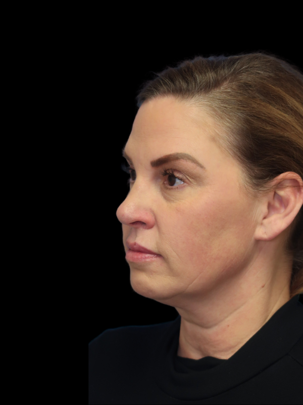 Deep Necklift Before & After