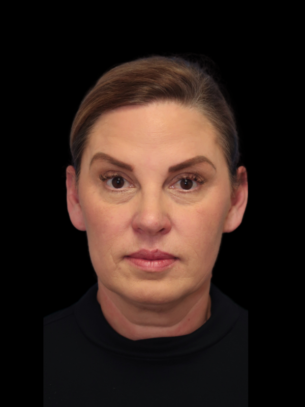 Deep Necklift Before & After