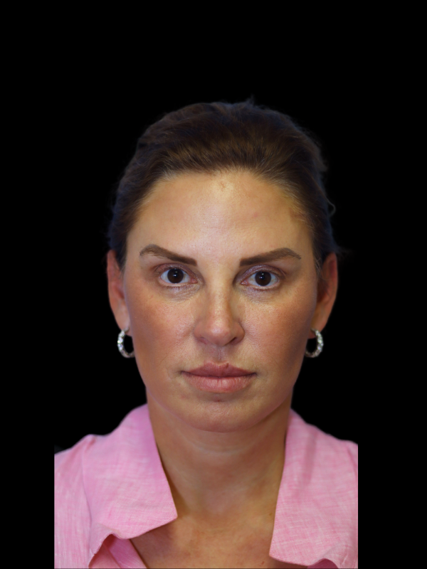 Deep Necklift Before & After