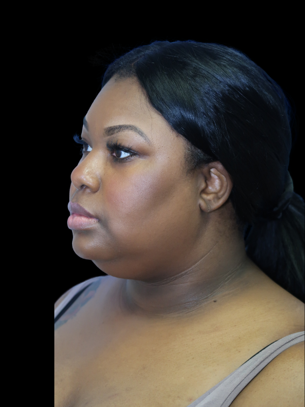 Deep Necklift Before & After