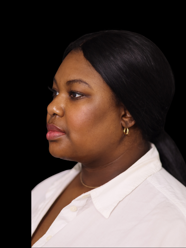 Deep Necklift Before & After