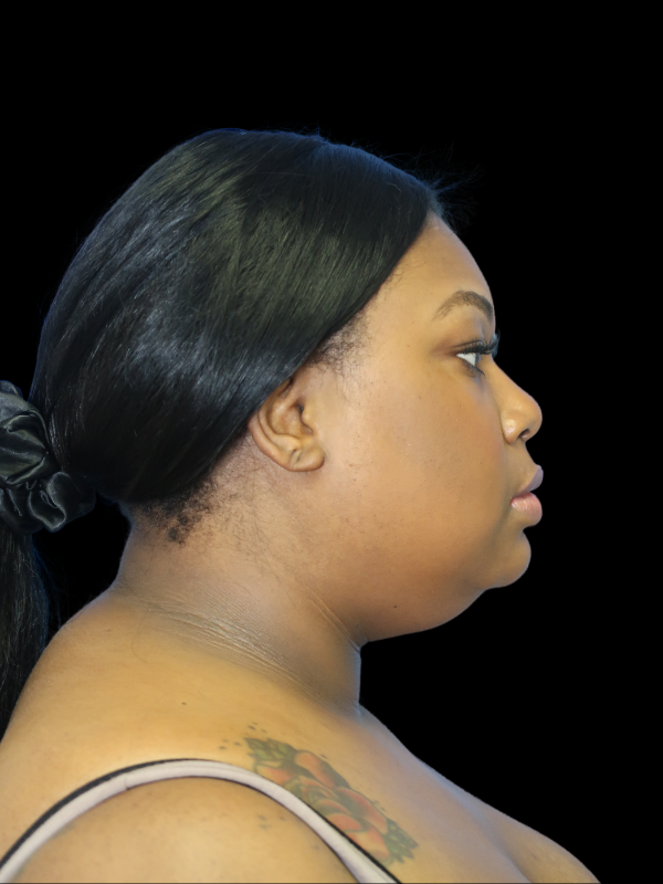 Deep Necklift Before & After