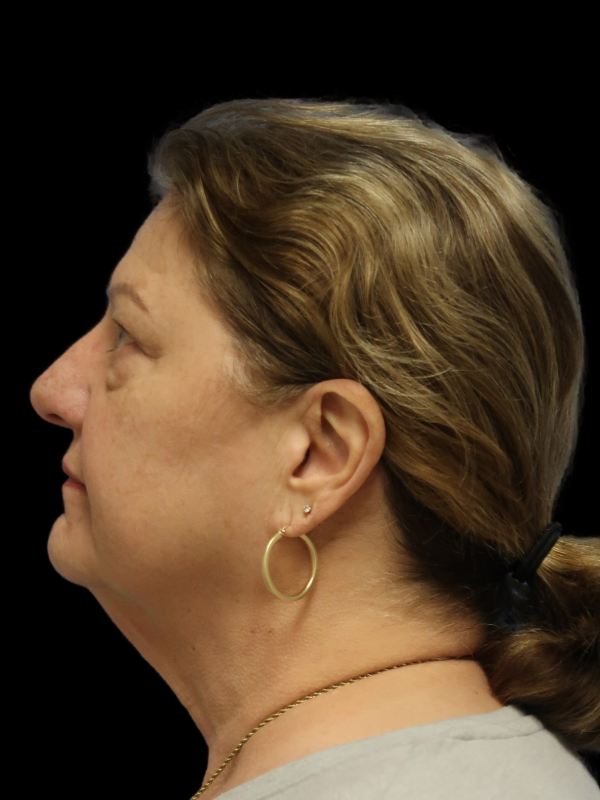 Facelift Neck Lift Before & After