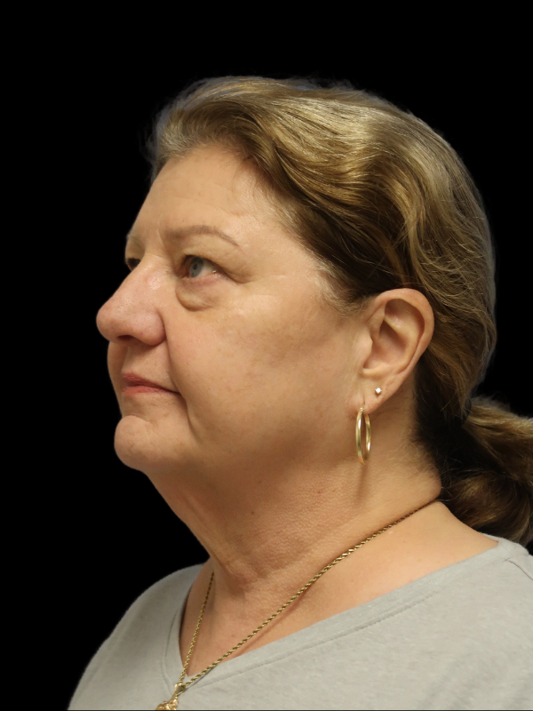 Facelift Neck Lift Before & After