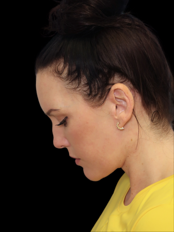 Deep Necklift Before & After