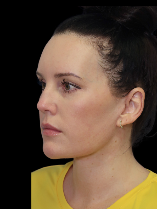 Facelift Neck Lift Before & After