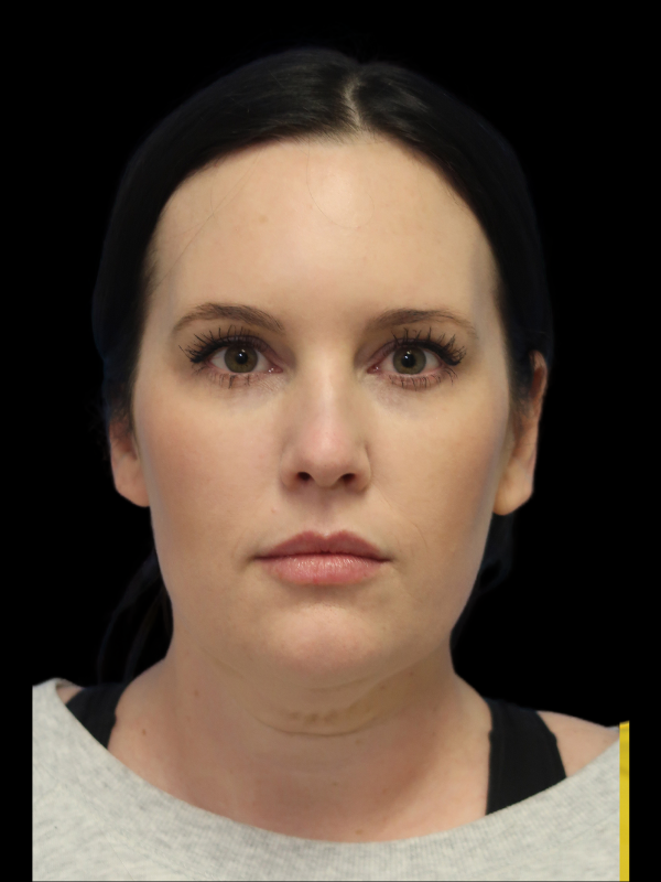 Facelift Neck Lift Before & After