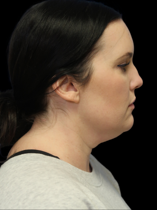 Facelift Neck Lift Before & After