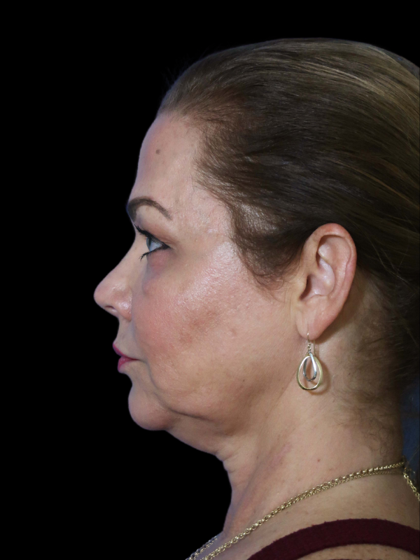 Facelift Neck Lift Before & After