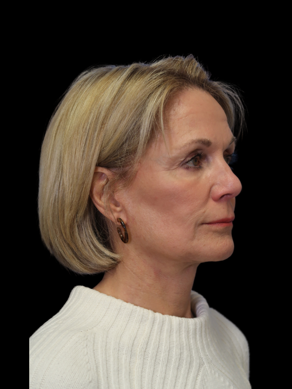 Facelift Neck Lift Before & After