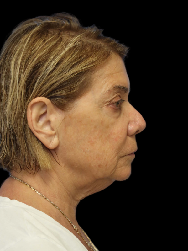 Facelift Neck Lift Before & After