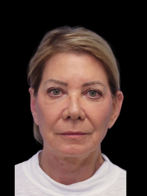 Facelift Neck Lift Before & After