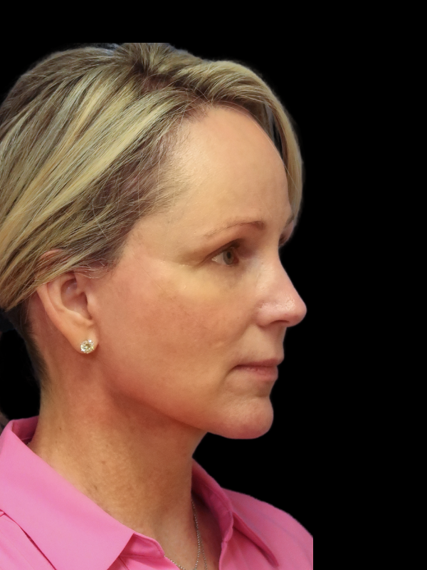 Deep Necklift Before & After