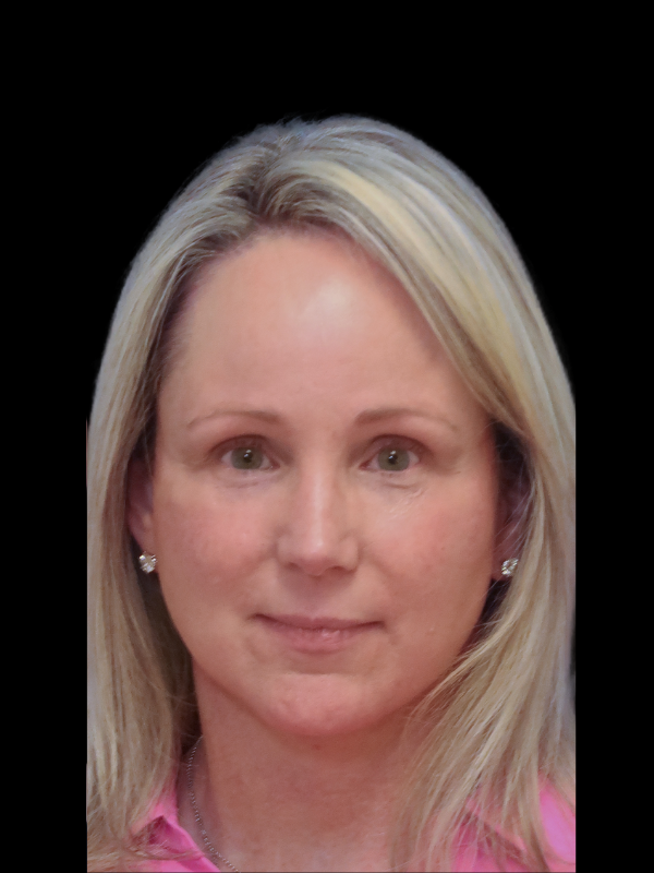 Deep Necklift Before & After