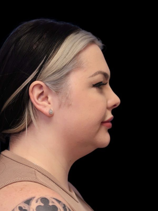 Deep Necklift Before & After