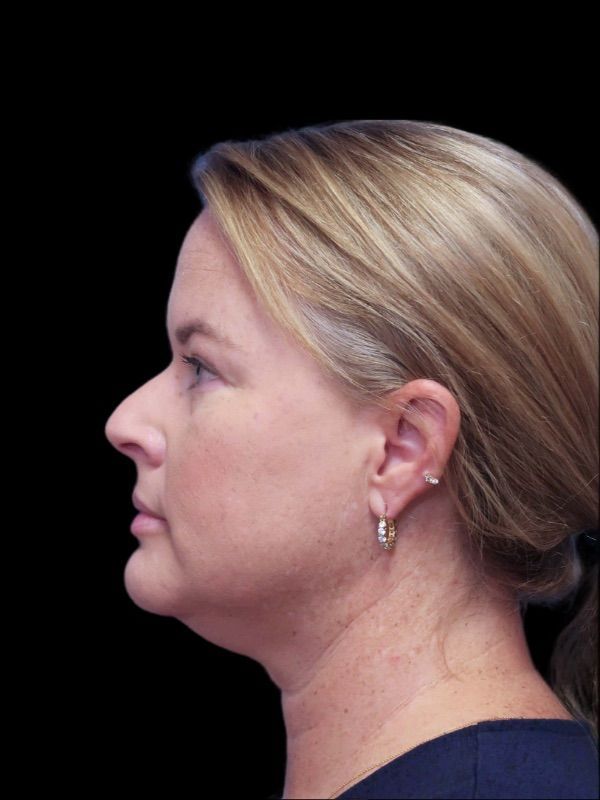 Deep Necklift Before & After