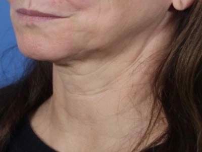 Morpheus 8 Before & After