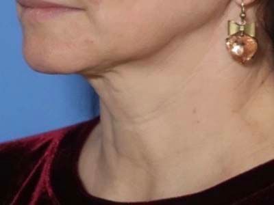 Morpheus 8 Before & After