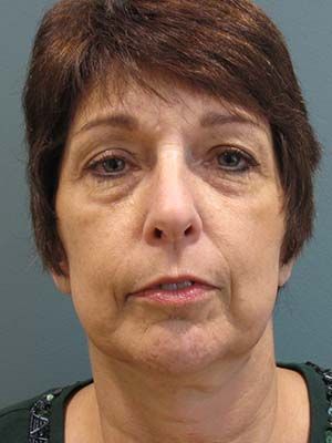 Sculptra Before & After