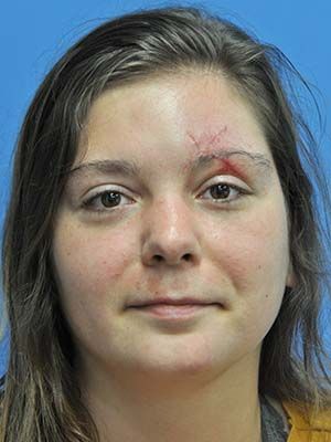 Scar Treatment Before & After