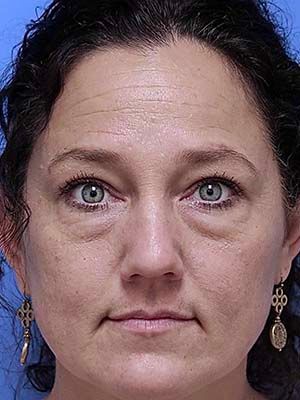 Chemical Peel Before & After