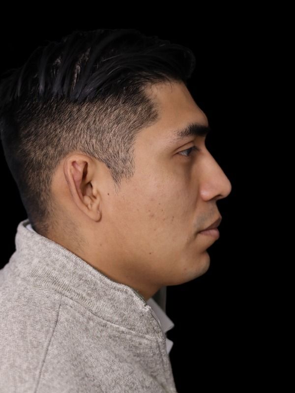 Rhinoplasty Before & After