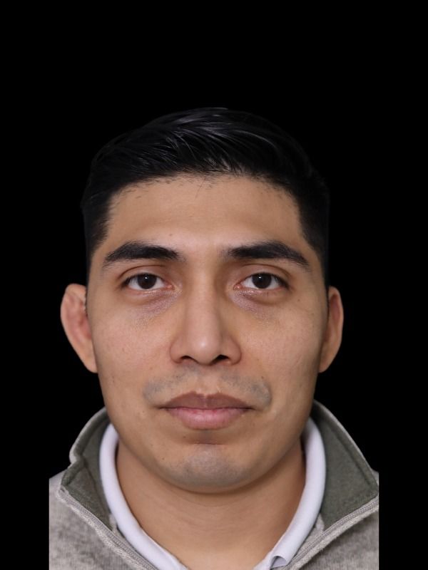 Rhinoplasty Before & After