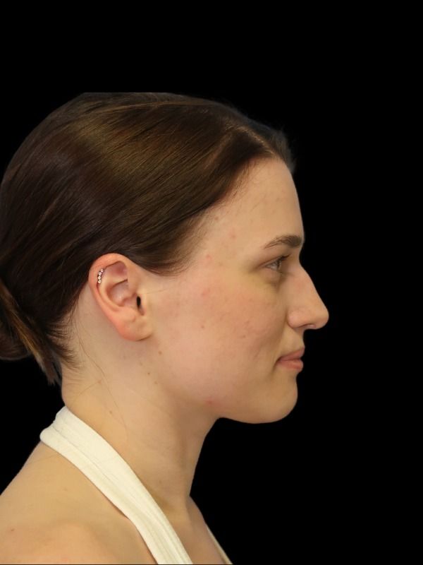 Rhinoplasty Before & After