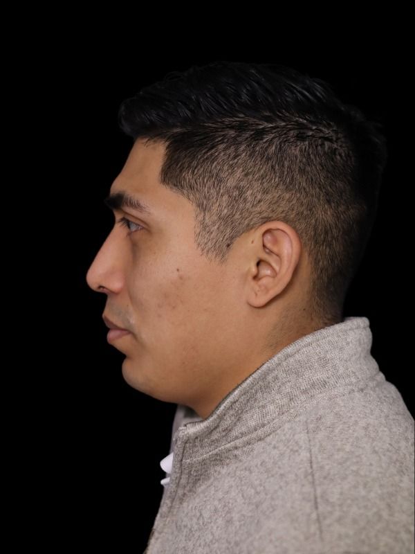 Rhinoplasty Before & After