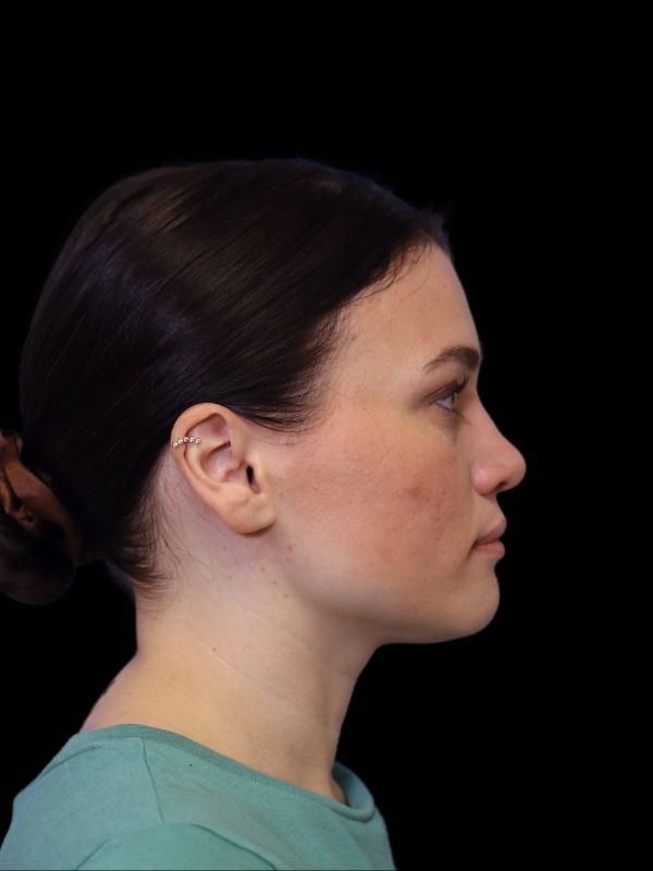 Rhinoplasty Before & After