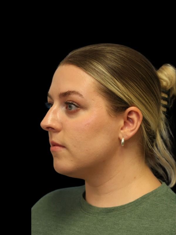 Rhinoplasty Before & After