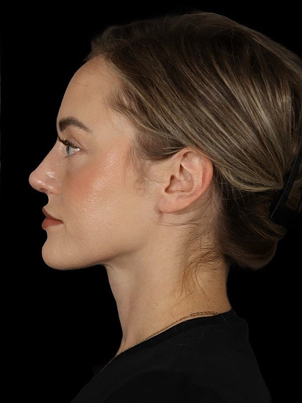 Rhinoplasty Before & After