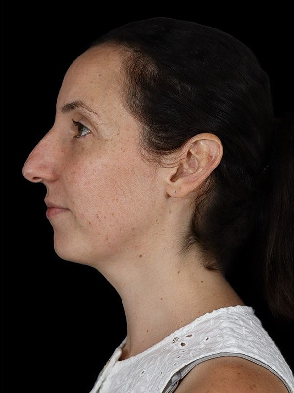 Rhinoplasty Before & After