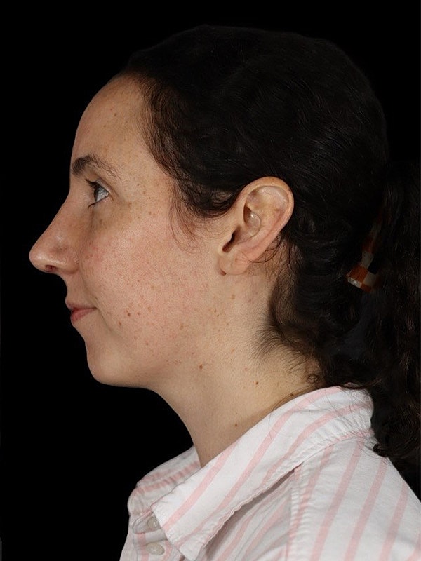 Rhinoplasty Before & After