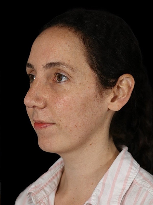 Rhinoplasty Before & After