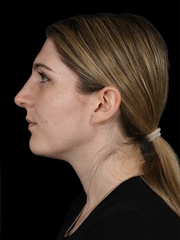 Rhinoplasty Before & After