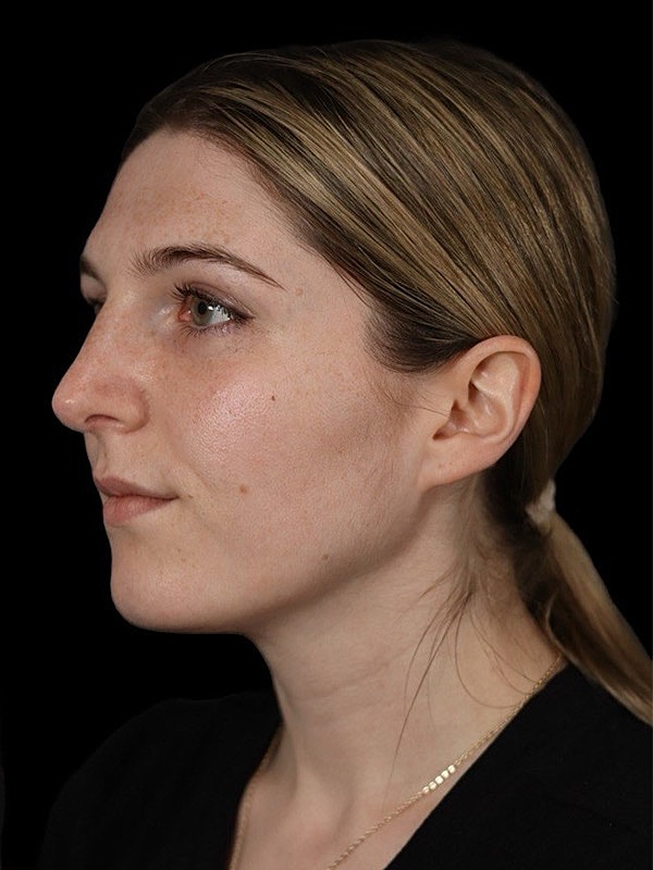 Rhinoplasty Before & After