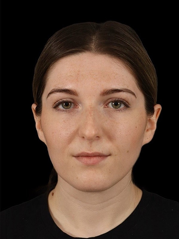 Rhinoplasty Before & After