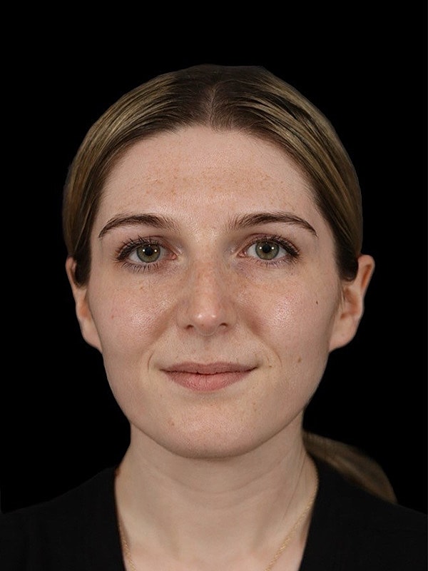 Rhinoplasty Before & After