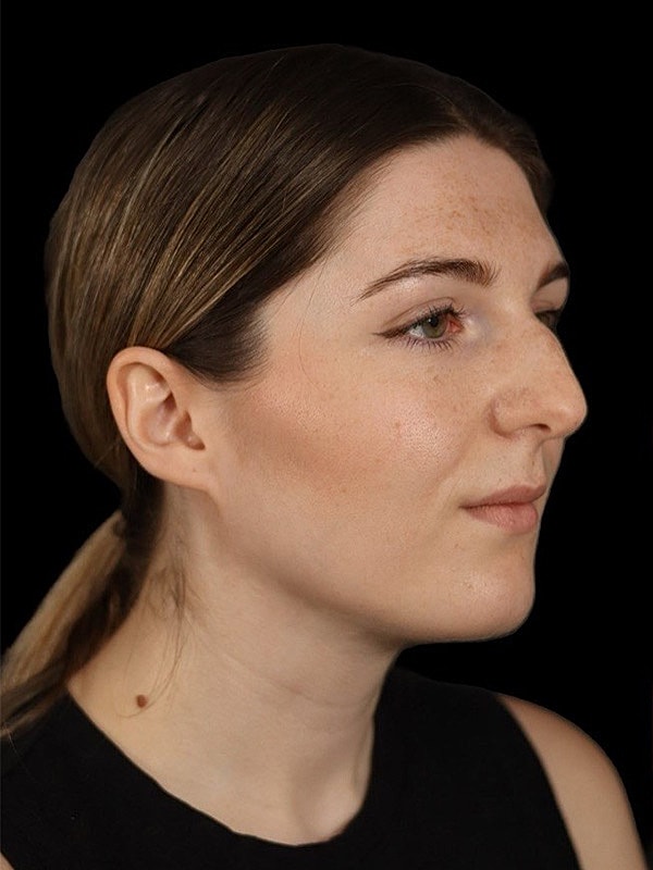 Rhinoplasty Before & After