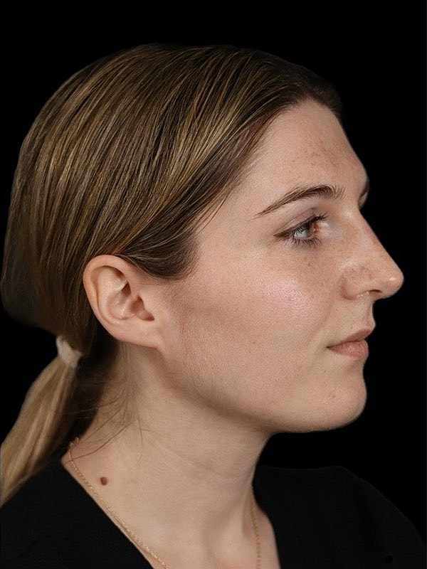 Rhinoplasty Before & After