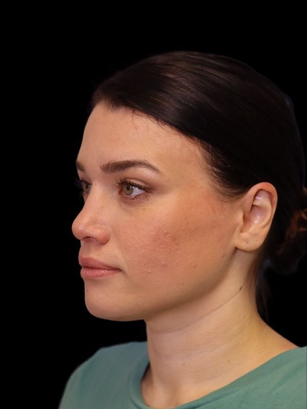 Rhinoplasty Before & After