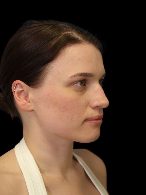 Rhinoplasty Before & After